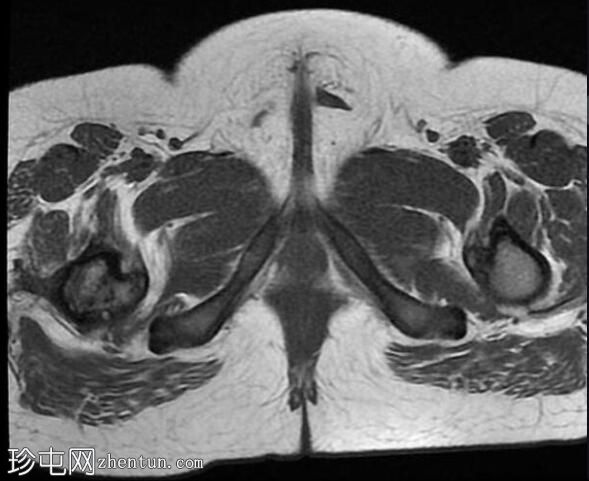 未降睾丸 (MRI)