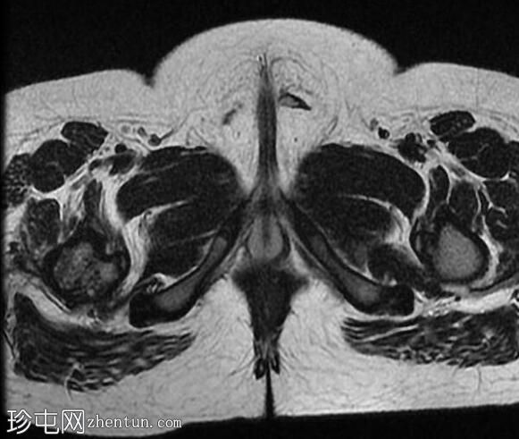 未降睾丸 (MRI)