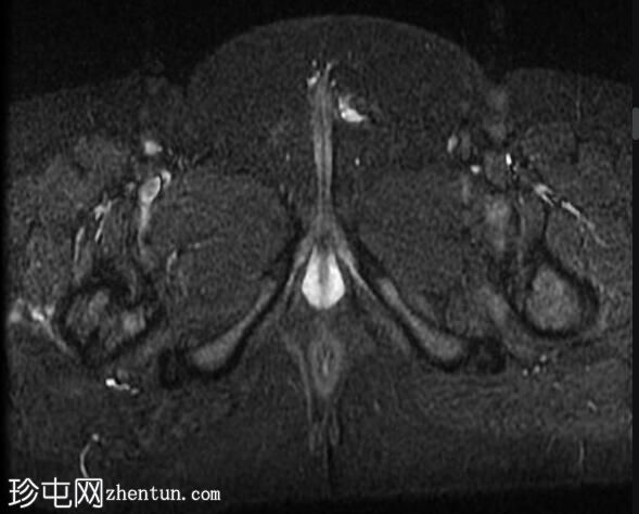 未降睾丸 (MRI)