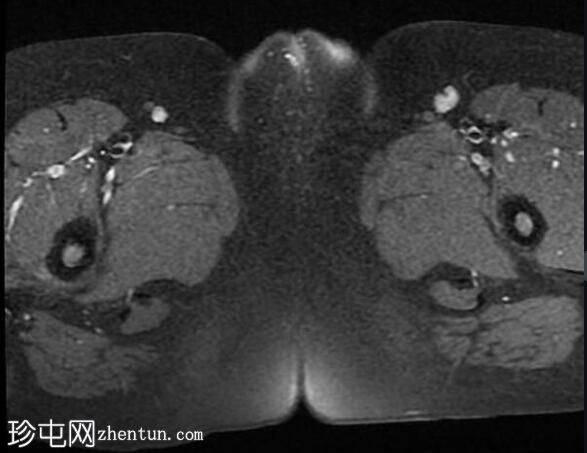 未降睾丸 (MRI)