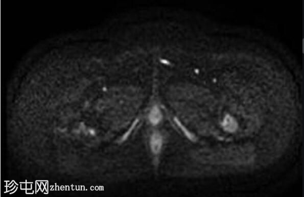 未降睾丸 (MRI)