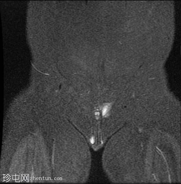 未降睾丸 (MRI)