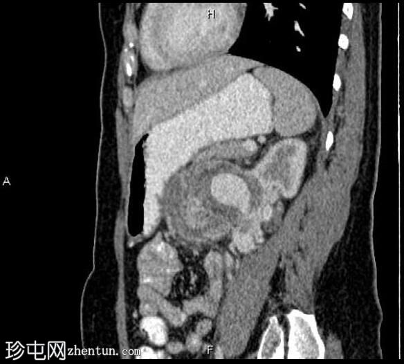 Wunderlich 综合征伴血管平滑肌脂肪瘤破裂引起的假性动脉瘤