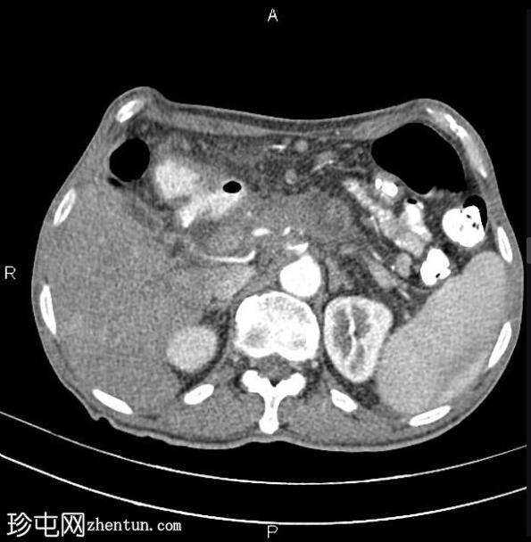 胰腺导管腺癌 - 不可切除