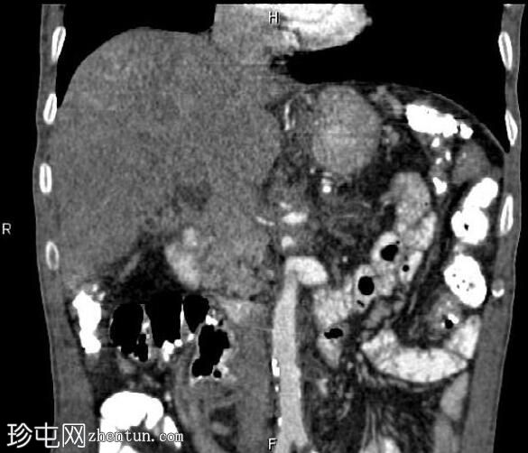 胰腺导管腺癌 - 不可切除