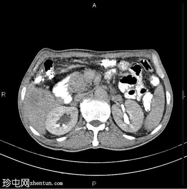 胰腺导管腺癌 - 不可切除