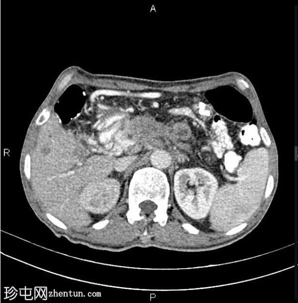 胰腺导管腺癌 - 不可切除