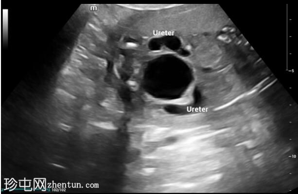 后尿道瓣膜（产前超声）