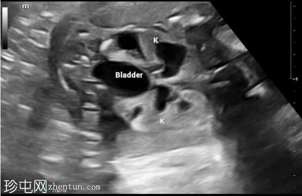 后尿道瓣膜（产前超声）