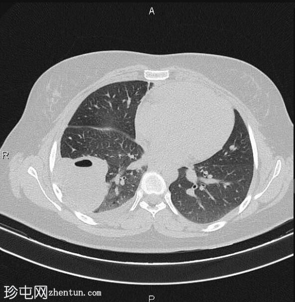 肺和肝包虫囊肿