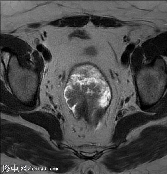 管状绒毛状腺瘤