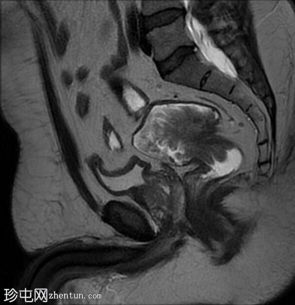 管状绒毛状腺瘤