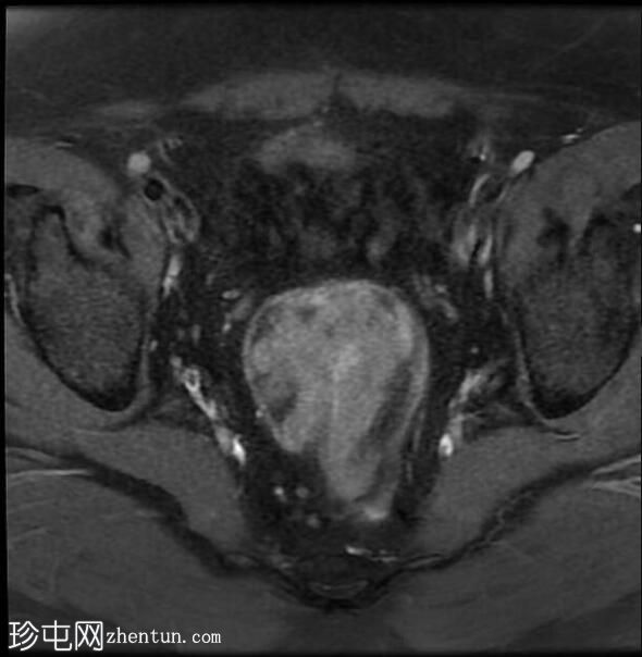 管状绒毛状腺瘤