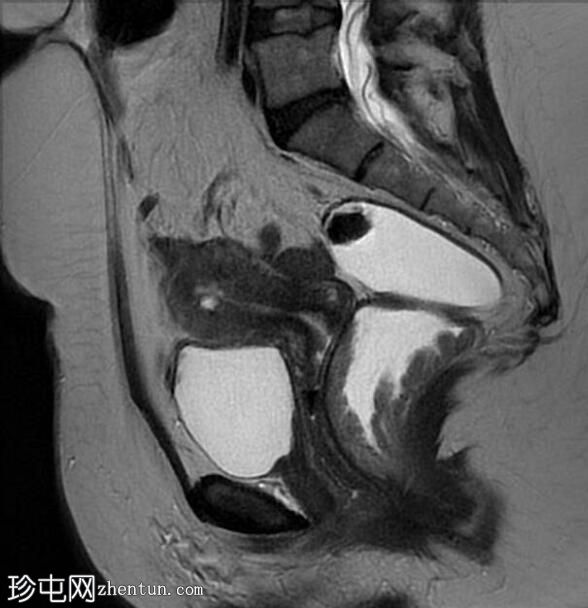 直肠绒毛状腺瘤