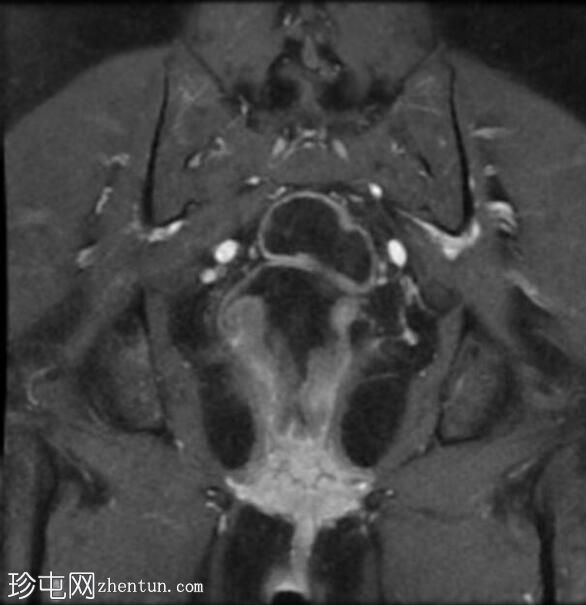 直肠绒毛状腺瘤