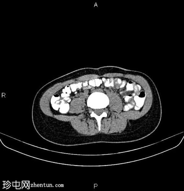 具有对侧未发育角的单角子宫 - a1b 型