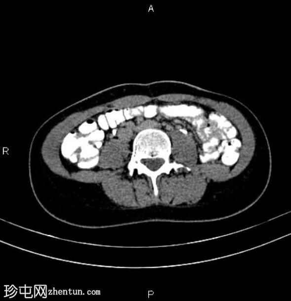 具有对侧未发育角的单角子宫 - a1b 型