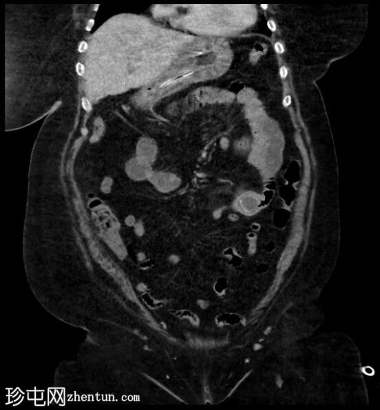 胆囊十二指肠瘘伴胆石性肠梗阻