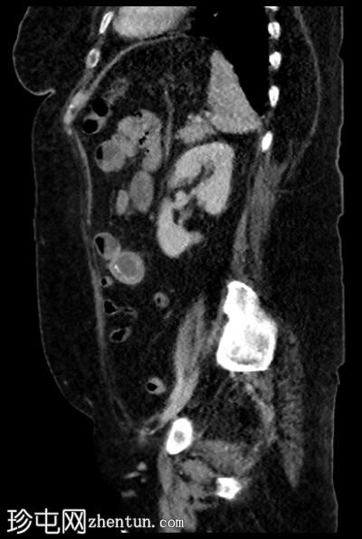 胆囊十二指肠瘘伴胆石性肠梗阻