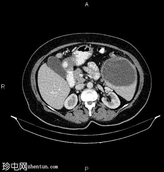 肝、脾包虫囊肿