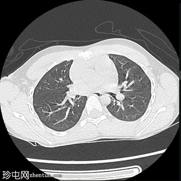 支气管异物