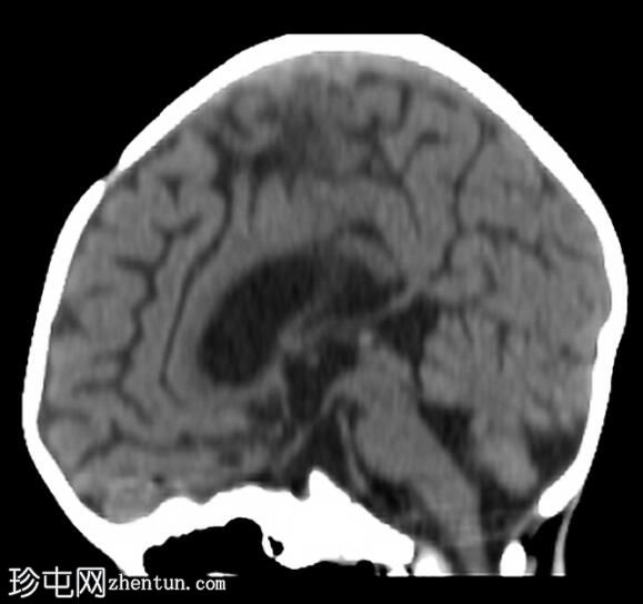 急性出血性白质脑炎 - 赫斯特病