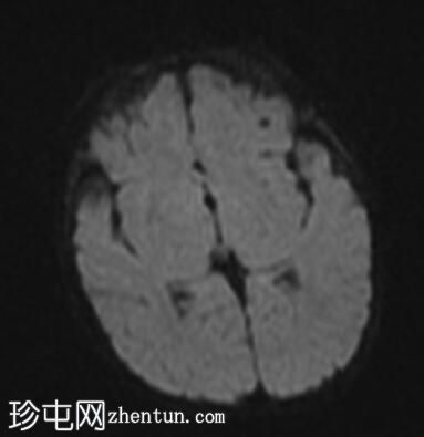 颅骨外窦