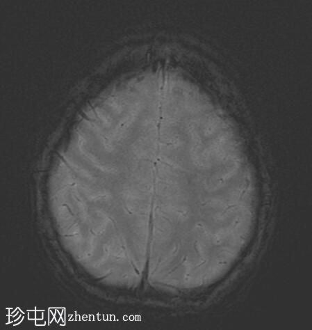 髓母细胞瘤