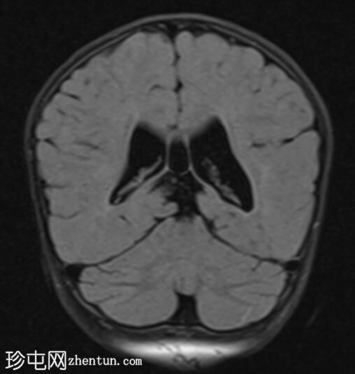 海马反转不完全