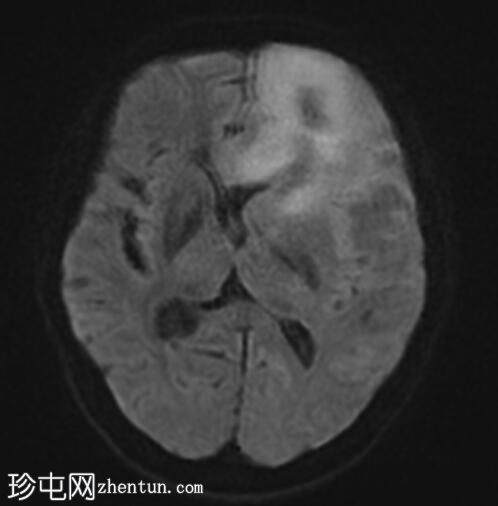 原发性中枢神经系统淋巴瘤