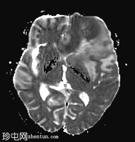 原发性中枢神经系统淋巴瘤