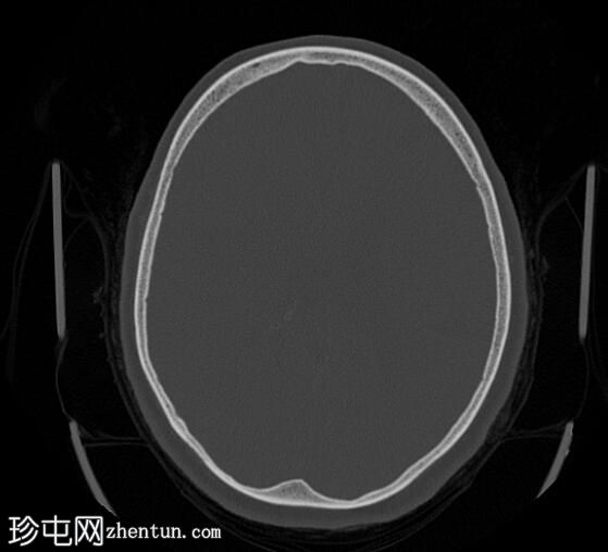 转移性子宫内膜癌