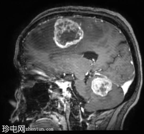 转移性子宫内膜癌