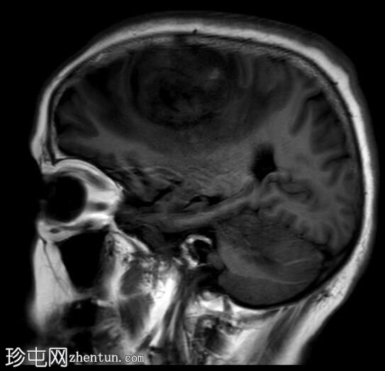 转移性子宫内膜癌