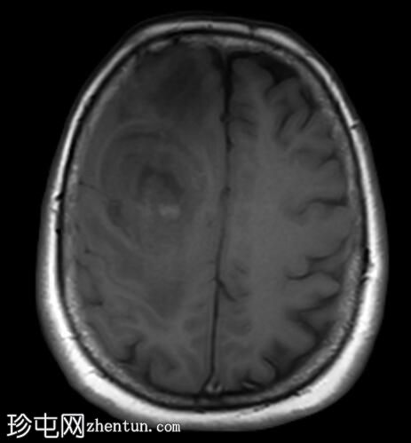 转移性子宫内膜癌