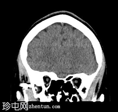 BB（滚珠轴承）子弹造成球体破裂