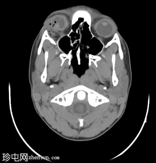 BB（滚珠轴承）子弹造成球体破裂