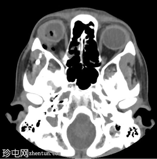 BB（滚珠轴承）子弹造成球体破裂