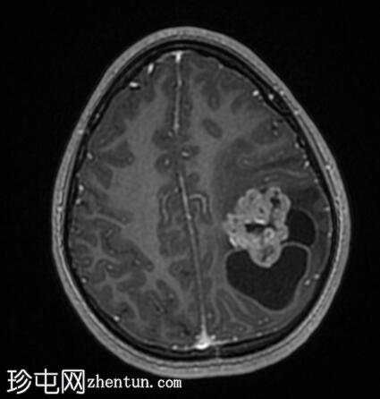 星形母细胞瘤