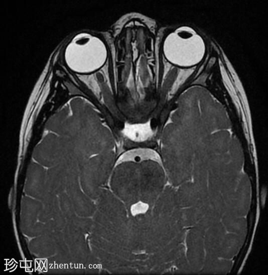 视神经胶质瘤
