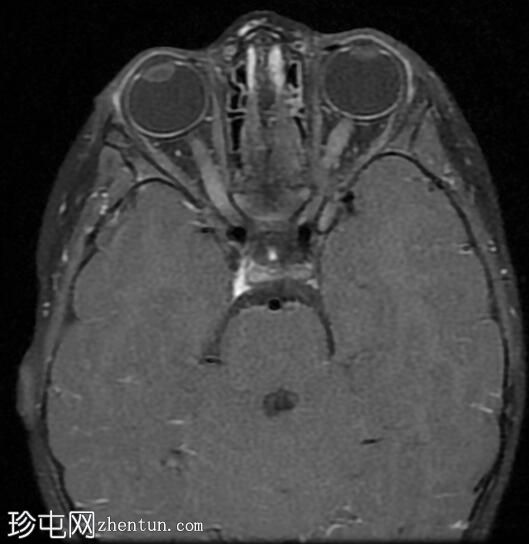 视神经胶质瘤