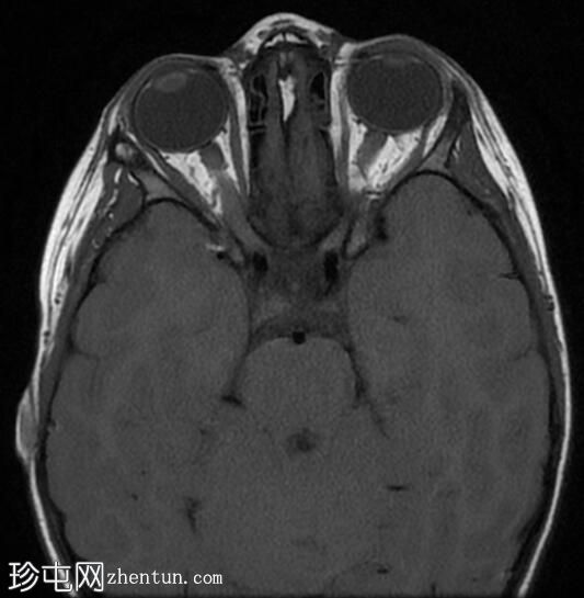 视神经胶质瘤