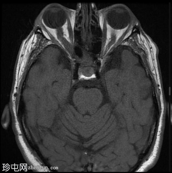 视神经脑膜瘤