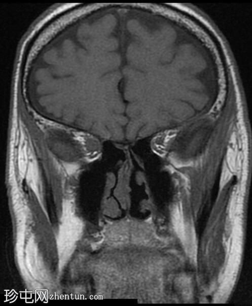 视神经脑膜瘤