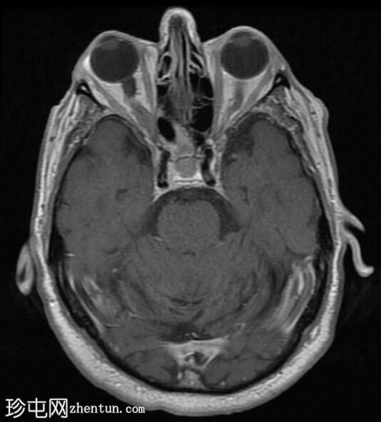视神经脑膜瘤