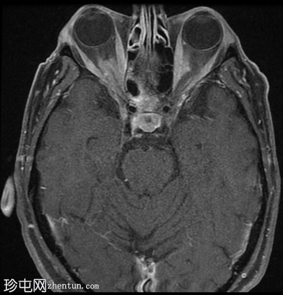 视神经脑膜瘤