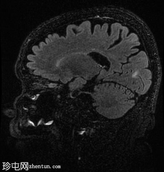 视神经脑膜瘤