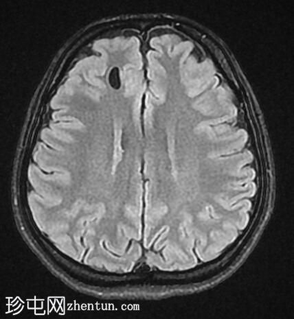 神经胶质囊肿