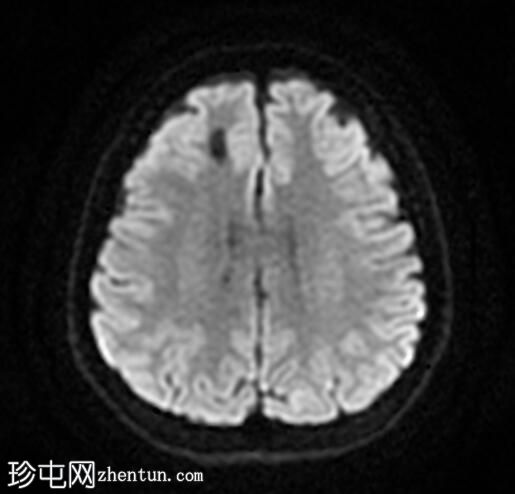 神经胶质囊肿