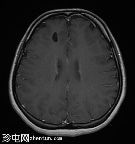 神经胶质囊肿